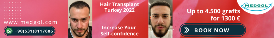 Hair Transplant in Antalya 